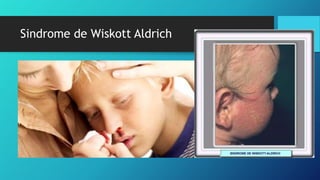 Sindrome de Wiskott Aldrich
 