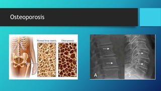 Osteoporosis
 