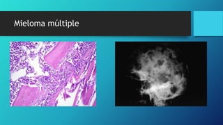 Mieloma múltiple
 
