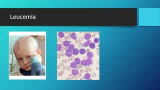 Leucemia
 