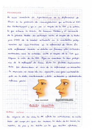 ^ISiop/iTDu:?6lA:
V A
de. /a ^/¿xndcíJa "^Vcic/cs. -¿o-r av» h'u,-^r^DJ" CCHÍTCU ei reccy^toi de /a fiirofiro-
j. • -j —j ¡ I .. I 1 L—j --j - - | - ' ' ' Í " - ^ - ^ ^ ^ - ^ ^ - j I .y > ^ .,^^. L . : _i j_ I •_
« J T O . ei^j&m^edcKci Yt^ti^tién se d e f e c a n con 'TreajeHcJcí ©MJ-S Qn+io^erpco
ci»i+7flroidc(M, CoKHo /OÍ Oia"/ícuerpoJ con/Tti el receptor d e /o. T-S/V ^ u c -
[ . 1 I I
fc^/30j;;aoK Q./ c/e ^ D J cf^arrifh^ ^ UIACL grcm c o n d a d de _
O j o n o r m a l
E x o f t a l m o s p o r
H i p e rt i r o id i s m o
A r ti^ í +/ 3 r e o m a Ttíi i d e .
-[^vioyor/a d e Jas vcíei> /^^ ct'^^c.ja ¡ Q A a r + i c ü / a d o n e j e^i Qi-vií>cuJ
lado^ del Cuerpo por ic^vrj. loJ t^vvrecas, /oj dedos de /a-^ W^^no-:^ /cij
I I j- j I I •. I i"^"' ¡ 
Vcd'//¿i5j ¡os ^i'ej y i jos iné^^JJ^-i .ro^t /oj resui~h*^ cv^c'^^dos ,
 