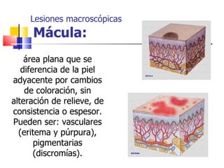 Lesiones macroscópicas
     Mácula:
    área plana que se
   diferencia de la piel
adyacente por cambios
    de coloración, sin
alteración de relieve, de
consistencia o espesor.
Pueden ser: vasculares
  (eritema y púrpura),
       pigmentarias
       (discromías).
 