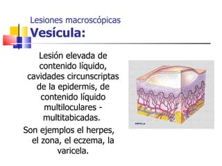 Lesiones macroscópicas
 Vesícula:
    Lesión elevada de
    contenido líquido,
 cavidades circunscriptas
   de la epidermis, de
     contenido líquido
      multiloculares -
      multitabicadas.
Son ejemplos el herpes,
  el zona, el eczema, la
         varicela.
 