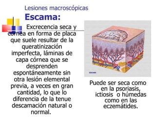Lesiones macroscópicas
      Escama:
       Excrecencia seca y
cornea en forma de placa
 que suele resultar de la
      queratinización
 imperfecta, láminas de
   capa córnea que se
       desprenden
  espontáneamente sin
  otra lesión elemental
                               Puede ser seca como
 previa, a veces en gran            en la psoriasis,
    cantidad, lo que lo          ictiosis o húmedas
  diferencia de la tenue              como en las
 descamación natural o               eczemátides.
         normal.
 