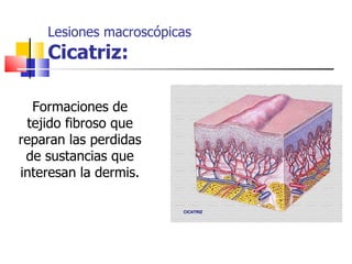 Lesiones macroscópicas
    Cicatriz:

  Formaciones de
 tejido fibroso que
reparan las perdidas
 de sustancias que
interesan la dermis.
 