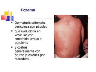 Eczema


   Dermatosis eritemato
    vesiculosa con pápulas
   que evoluciona en
    vesículas con
    contenido seroso o
    purulento
   y costras
    generalmente con
    prurito y lesiones por
    rascadura.
 
