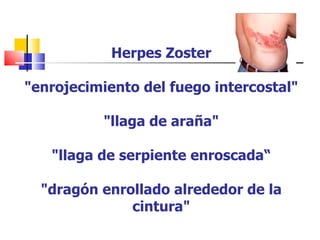 Herpes Zoster

"enrojecimiento del fuego intercostal"

          "llaga de araña"

   "llaga de serpiente enroscada“

  "dragón enrollado alrededor de la
              cintura"
 
