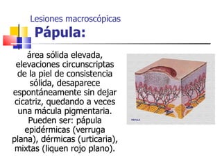 Lesiones macroscópicas
      Pápula:
     área sólida elevada,
 elevaciones circunscriptas
  de la piel de consistencia
      sólida, desaparece
espontáneamente sin dejar
 cicatriz, quedando a veces
  una mácula pigmentaria.
     Pueden ser: pápula
    epidérmicas (verruga
plana), dérmicas (urticaria),
 mixtas (liquen rojo plano).
 