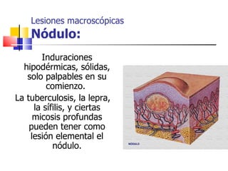 Lesiones macroscópicas
    Nódulo:
       Induraciones
  hipodérmicas, sólidas,
   solo palpables en su
         comienzo.
La tuberculosis, la lepra,
     la sífilis, y ciertas
     micosis profundas
    pueden tener como
    lesión elemental el
           nódulo.
 