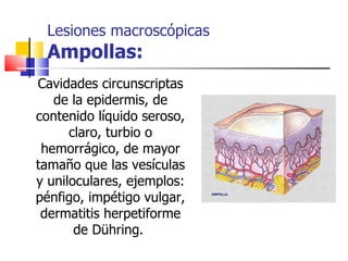 Lesiones macroscópicas
 Ampollas:
Cavidades circunscriptas
   de la epidermis, de
contenido líquido seroso,
      claro, turbio o
 hemorrágico, de mayor
tamaño que las vesículas
y uniloculares, ejemplos:
pénfigo, impétigo vulgar,
 dermatitis herpetiforme
       de Dühring.
 