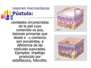 Lesiones macroscópicas
Pústula:
cavidades circunscriptas
      de la piel cuyo
    contenido es pus,
 lesiones primarias que
  desde s u comienzo
    son purulentas, a
     diferencia de las
  vesículas supuradas.
   Ejemplos: impétigo
      producido por
 estafilococo, foliculitis.
 