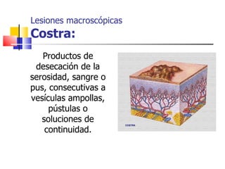Lesiones macroscópicas
Costra:
   Productos de
 desecación de la
serosidad, sangre o
pus, consecutivas a
vesículas ampollas,
     pústulas o
   soluciones de
    continuidad.
 