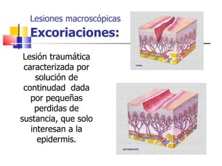 Lesiones macroscópicas
  Excoriaciones:
 Lesión traumática
 caracterizada por
    solución de
 continudad dada
   por pequeñas
    perdidas de
sustancia, que solo
   interesan a la
     epidermis.
 