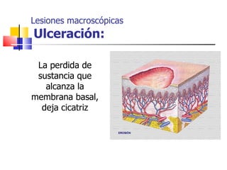 Lesiones macroscópicas
Ulceración:

 La perdida de
 sustancia que
   alcanza la
membrana basal,
  deja cicatriz
 
