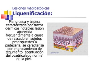 Lesiones macroscópicas
    Liquenificación:
  Piel gruesa y áspera
caracterizada por trazos
dérmicos notables lesión
        aparecida
frecuentemente a causa
 de rascado en sujetos
    predispuestos a
padecerla, se caracteriza
 por engrosamiento de
tegumento, acentuación
del cuadriculado normal
        de la piel.
 