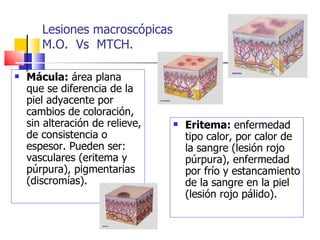 Lesiones macroscópicas
       M.O. Vs MTCH.

   Mácula: área plana
    que se diferencia de la
    piel adyacente por
    cambios de coloración,
    sin alteración de relieve,      Eritema: enfermedad
    de consistencia o                tipo calor, por calor de
    espesor. Pueden ser:             la sangre (lesión rojo
    vasculares (eritema y            púrpura), enfermedad
    púrpura), pigmentarias           por frío y estancamiento
    (discromías).                    de la sangre en la piel
                                     (lesión rojo pálido).
 