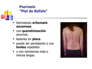 Psoriasis
      "Piel de Búfalo"


   Dermatosis eritemato
    escamosa
   con queratinización
    anormal,
   lesiones en placa
   puede ser persistente o con
    brotes repetidos
   y con remisiones más o
    menos largas.
 