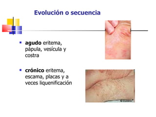 Evolución o secuencia



   agudo eritema,
    pápula, vesícula y
    costra

   crónico eritema,
    escama, placas y a
    veces liquenificación
 