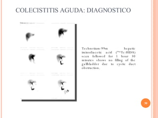 COLECISTITIS AGUDA: DIAGNOSTICO Technetium-99m hepatic iminodiacetic acid ( 99m Tc-HIDA) scan followed for 1 hour 30 minut...