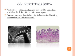 COLECISTITIS CRONICA <ul><li>Pacientes con  litiasis biliar  que han sufrido  episodios repetidos de dolor biliar o coleci...