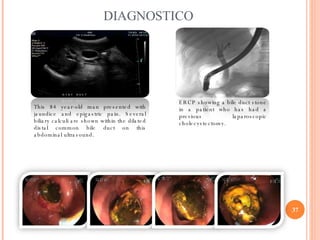 DIAGNOSTICO This 84 year-old man presented with jaundice and epigastric pain. Several biliary calculi are shown within the...