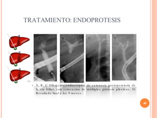 TRATAMIENTO: ENDOPROTESIS A, B, C Dilatación endoscópica de estenosis postoperatoria de la vía biliar, con colocación de m...