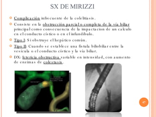 SX DE MIRIZZI <ul><li>Complicación   infrecuente de la colelitiasis. </li></ul><ul><li>Consiste en la  obstrucción parcial...