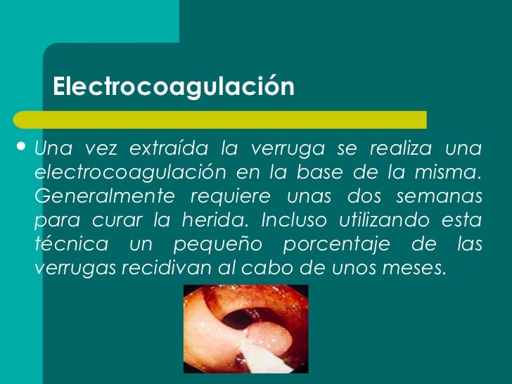 Duele la espalda en oblosti de los riñones