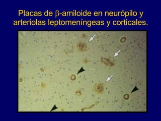 Placas de   -amiloide en neurópilo y arteriolas leptomeníngeas y corticales. 