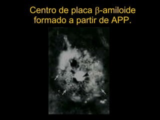 Centro de placa   -amiloide formado a partir de APP. 