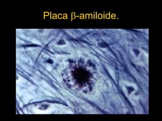 Placa   -amiloide. 