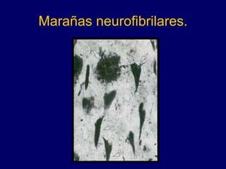 Marañas neurofibrilares. 