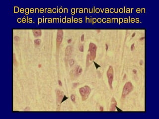Degeneración granulovacuolar en céls. piramidales hipocampales. 