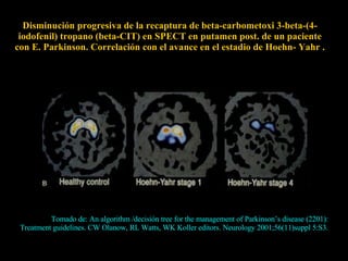 Disminución progresiva de la recaptura de beta-carbometoxi 3-beta-(4-iodofenil) tropano (beta-CIT) en SPECT en putamen post. de un paciente con E. Parkinson. Correlación con el avance en el estadio de Hoehn- Yahr . Tomado de: An algorithm /decisión tree for the management of Parkinson’s disease (2201):  Treatment guidelines. CW Olanow, RL Watts, WK Koller editors. Neurology 2001;56(11)suppl 5:S3.  