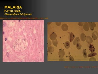 MALARIA
PATOLOGÍA
Plasmodium falciparum
 