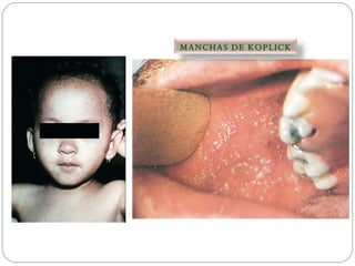 MANCHAS DE KOPLICK 