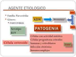 AGENTE ETIOLOGICO Familia: Parvoviridae Género: PARVOVIRUS ADN Proteinas PV1 PV2 Serotipo B19 Célula eritroide Células con actividad mitótica Células progenitoras eritoides humanas y eritroblastos Infección citotóxica Inmunocomplejos Lisis PATOGENIA 