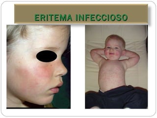 ERITEMA INFECCIOSO 