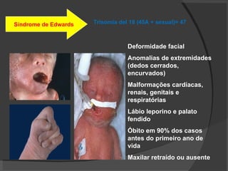 Síndrome de Edwards Trisomía   del  18 (45A + sexual)= 47 Deformidade facial Anomalias de extremidades (dedos cerrados, encurvados) Malformações cardíacas, renais, genitais e respiratórias Lábio leporino e palato fendido Óbito em 90% dos casos antes do primeiro ano de vida Maxilar retraído ou ausente 