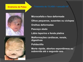 Trissomia do 13 (45A + sexual)= 47 Síndrome de Patau Microcefalia e face deformada Olhos pequenos, ausentes ou cíclopes Orelhas deformadas Pescoço alado Lábio leporino e fenda platina Malformações cardíacas, renais, digestivas Polidactilia  Morte rápida, abortos espontâneos ou sobrevida até o segundo ano 