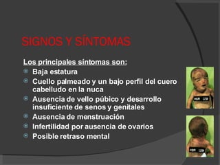 SIGNOS Y SÍNTOMAS Los principales síntomas son:   Baja estatura  Cuello palmeado y un bajo perfil del cuero cabelludo en la nuca  Ausencia de vello púbico y desarrollo insuficiente de senos y genitales  Ausencia de menstruación  Infertilidad por ausencia de ovarios  Posible retraso mental  
