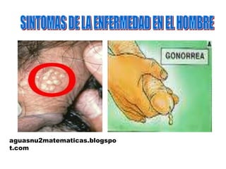 SINTOMAS DE LA ENFERMEDAD EN EL HOMBREaguasnu2matematicas.blogspot.com