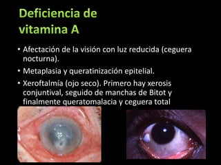 • Afectación de la visión con luz reducida (ceguera 
nocturna). 
• Metaplasia y queratinización epitelial. 
• Xeroftalmía (ojo seco). Primero hay xerosis 
conjuntival, seguido de manchas de Bitot y 
finalmente queratomalacia y ceguera total 
 