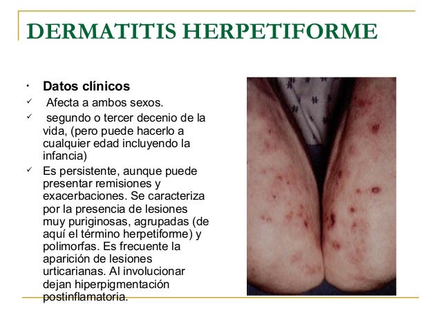 El ungüento en el aceite de espino cerval de mar de la psoriasis
