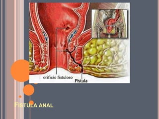 FÍSTULA ANAL
 