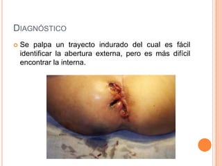 DIAGNÓSTICO
   Se palpa un trayecto indurado del cual es fácil
    identificar la abertura externa, pero es más difícil
    encontrar la interna.
 