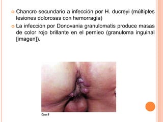  Chancro secundario a infección por H. ducreyi (múltiples
  lesiones dolorosas con hemorragia)
 La infección por Donovania granulomatis produce masas
  de color rojo brillante en el pernieo (granuloma inguinal
  [imagen]).
 