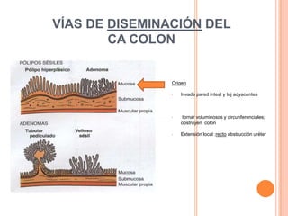 VÍAS DE DISEMINACIÓN DEL
        CA COLON


                Origen

                •   Invade pared intest y tej adyacentes



                •   tornar voluminosos y circunferenciales;
                    obstruyen colon

                •   Extensión local :recto obstrucción uréter
 