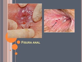 FISURA ANAL
 