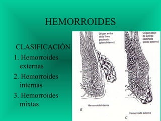 HEMORROIDES
CLASIFICACIÓN
1. Hemorroides
externas
2. Hemorroides
internas
3. Hemorroides
mixtas
 